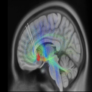 زراعة سلكين (يظهران في الرسم على هيئة خطين أبيضين) يحملان أقطابًا كهربية في منطقة في الدماغ تُسمى القشرة الحزامية تحت الثفنية، ومنها تنتشر ألياف عصبية (تظهر ملونة) إلى المناطق الأخرى.